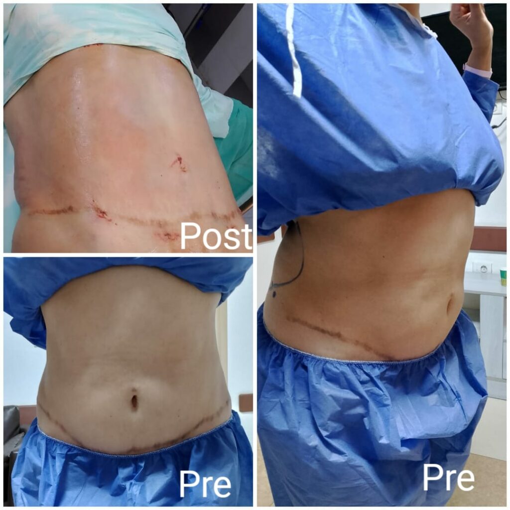Tummy tuck and liposuction before and after